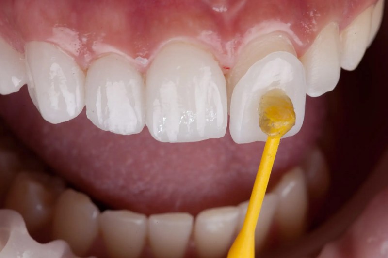 mejor dentista en miami, carillas de porcelana en miami, Botox miami, costo del tratamiento de conducto en miami, elevación de seno nasal en miami, mejores carillas en miami, mejor dentista del sur de florida, mejor dentista cosmético en miami, mejor atención dental en miami, sage dental